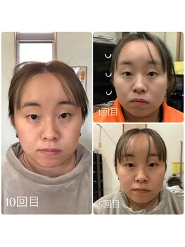 かず整骨院/光美容で小顔に！