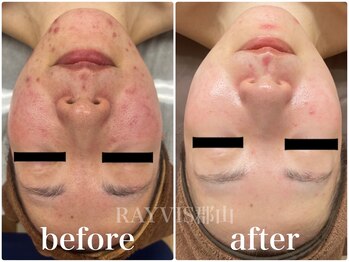 レイビス 郡山店(RAYVIS)/お肌・ ニキビ・毛穴ケア1