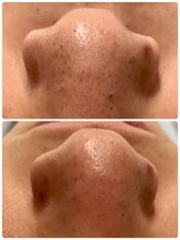 メンズ脱毛＆ヘッドスパ MEN'S with Lilina. 新横浜［ヒゲ脱毛/全身脱毛/VIO脱毛］/ハイドラ1回目　/新横浜/菊名