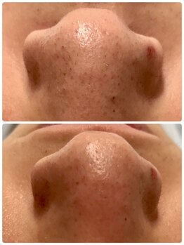 メンズ脱毛＆ヘッドスパ MEN'S with Lilina. 新横浜［ヒゲ脱毛/全身脱毛/VIO脱毛］/ハイドラ1回目　/新横浜/菊名