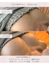 キレイバスト(Kireiii Bust)/ビフォーアフター