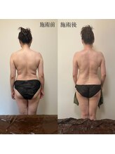 リセット(Reset.)/深層筋リンパ／ before → after