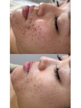 セン(Sen)/肌荒れ改善