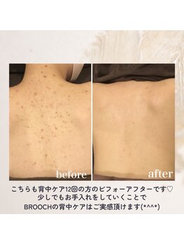 ブローチ 岡崎店(BROOCH)/背中の施術後効果抜群◎