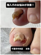 巻き爪じゅん 船橋店/陥入爪の痛みを根本から改善