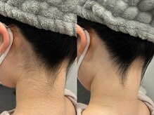 フェイシャルクレア(Cre A.)/うなじ脱毛【Mパーツ】