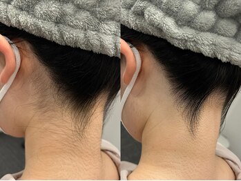 フェイシャルクレア(Cre A.)/うなじ脱毛【Mパーツ】