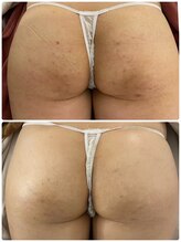 ニコリー(NICOLY)/ヒップ陶肌トリートメント