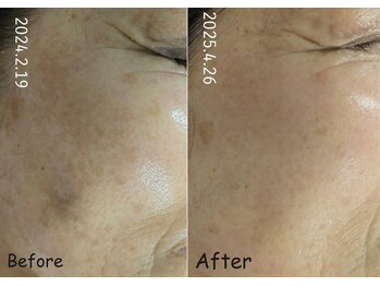 マインドール/70代でもシミは変化します!