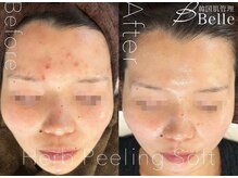 ベル 代々木店(Belle)/ニキビケア施術例