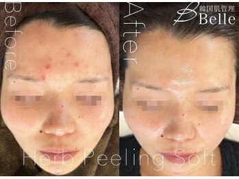 ベル 代々木店(Belle)/ニキビケア施術例