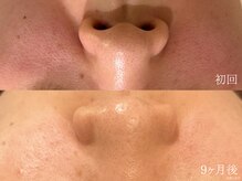 ウォーム(warm)/毛穴/毛穴洗浄/毛穴ケア/毛穴