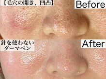 エミナル(eminal)の雰囲気（毛穴汚れごっそり除去。特許技術なので安心です。）