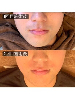 ビダンドウ(BIDANDO)/メンズ【人気No,1】ヒゲ脱毛