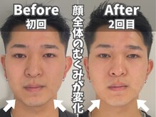 鍼灸整体院ユー(鍼灸整体院You...)/美容鍼×小顔矯正　施術後の変化