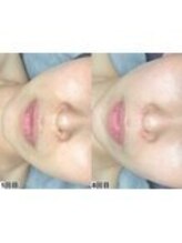 アンドミー 鹿児島中山(&me)/ララピール【艶肌/美白/くすみ】