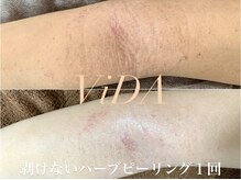 ヴィーダ 渋谷松濤(ViDA)/腕の肌質改善