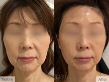 ティアラッシュ(TiaLash)/光フェイシャル×筋膜2回