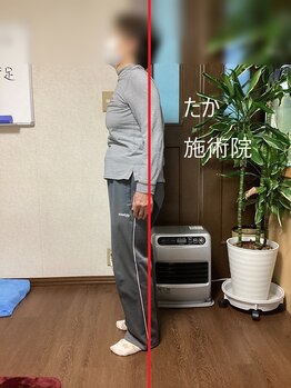 たか施術院/《姿勢矯正》猫背　腰痛