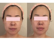 リファラ 光の森店(REFALA)/毛穴・ニキビケア専門REFALA