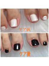 ココプラス(COCO+)/巻き爪ケア