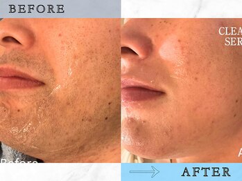 ラッシュ(RUSH)/13回でヒゲ脱毛完了!