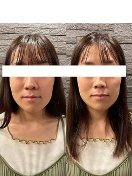 長寿鍼灸院 長寿整骨院/美容鍼25本の効果★左右バランス