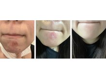 アルゴ 吹田千里山駅前店(ALGO)/美容液のみで劇的変化！