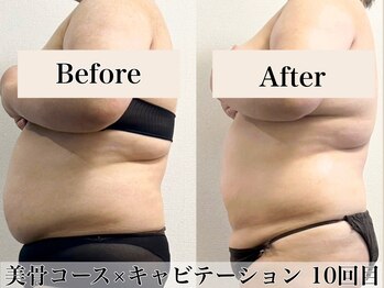 アトレセカンドボディ(Attrait second body)/Before→After【10回目】痩身