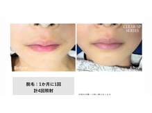 サロン ルアナ(salon luana)/レディース顔脱毛before→after