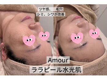 アムール(Amour)/ララピール水光肌