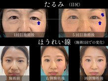 ネクスフィット(Nexfit)