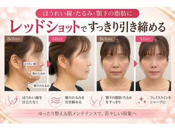 ラシクビューティールームの写真/40代からのほうれい線・たるみが気になる方へ