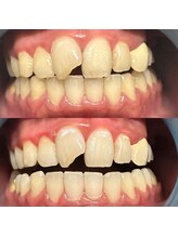 メンズ脱毛 リボーン(reborn)/セルフホワイトニング