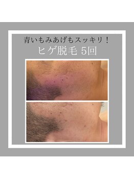 ロカヒ(Lokahi)/青ヒゲすっきりであか抜け印象！