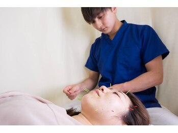 かげやま鍼灸接骨院/お顔の鍼