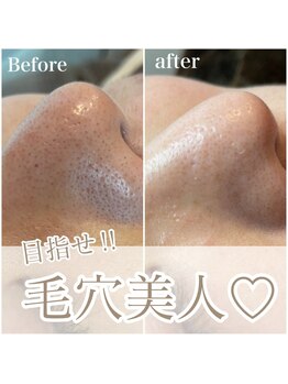 セレン(Seren)/毛穴洗浄でツルツルなお肌へ♪