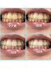 20分×8回♪セルフホワイトニング回数券￥11500（1回¥1437）