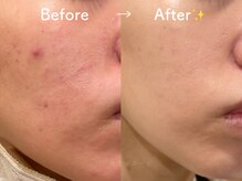 セラピエージ/肌質改善