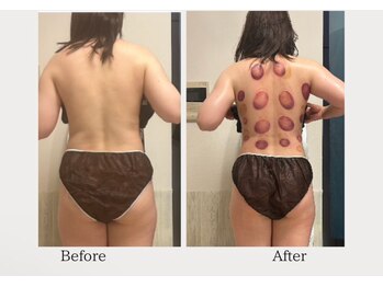 オーシャンブルーム 目黒(OceanBloom)/リンパマッサージハイパーナイフ