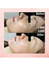 ミラン(MiLaN)/毛穴洗浄/ハイドラヴィーナス