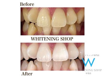 ホワイトニングショップ 甲賀店/Before&After『ホワイトニング』