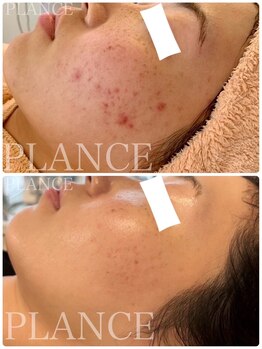 プランス 恵比寿店(PLANCE)/乾燥によるニキビ悩みにも