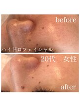 ステライチマルサン(stella.103)/ハイドロ毛穴洗浄