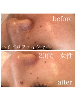 ステライチマルサン(stella.103)/ハイドロ毛穴洗浄