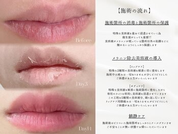 フォンビューティー(fon beauty)/【ローマピンク】