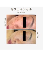 エステサロン 美飾り イオンモール木更津店/before⇒afteｒ/光フェイシャル