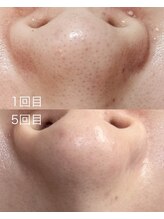 マテリアル(Material`)/REVI(ルヴィ) ハーブピーリング