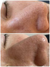 ルネ(Rune)/毛穴洗浄　