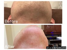 ビダン(BIDAN)/ヒゲ脱毛　BeforeAfter